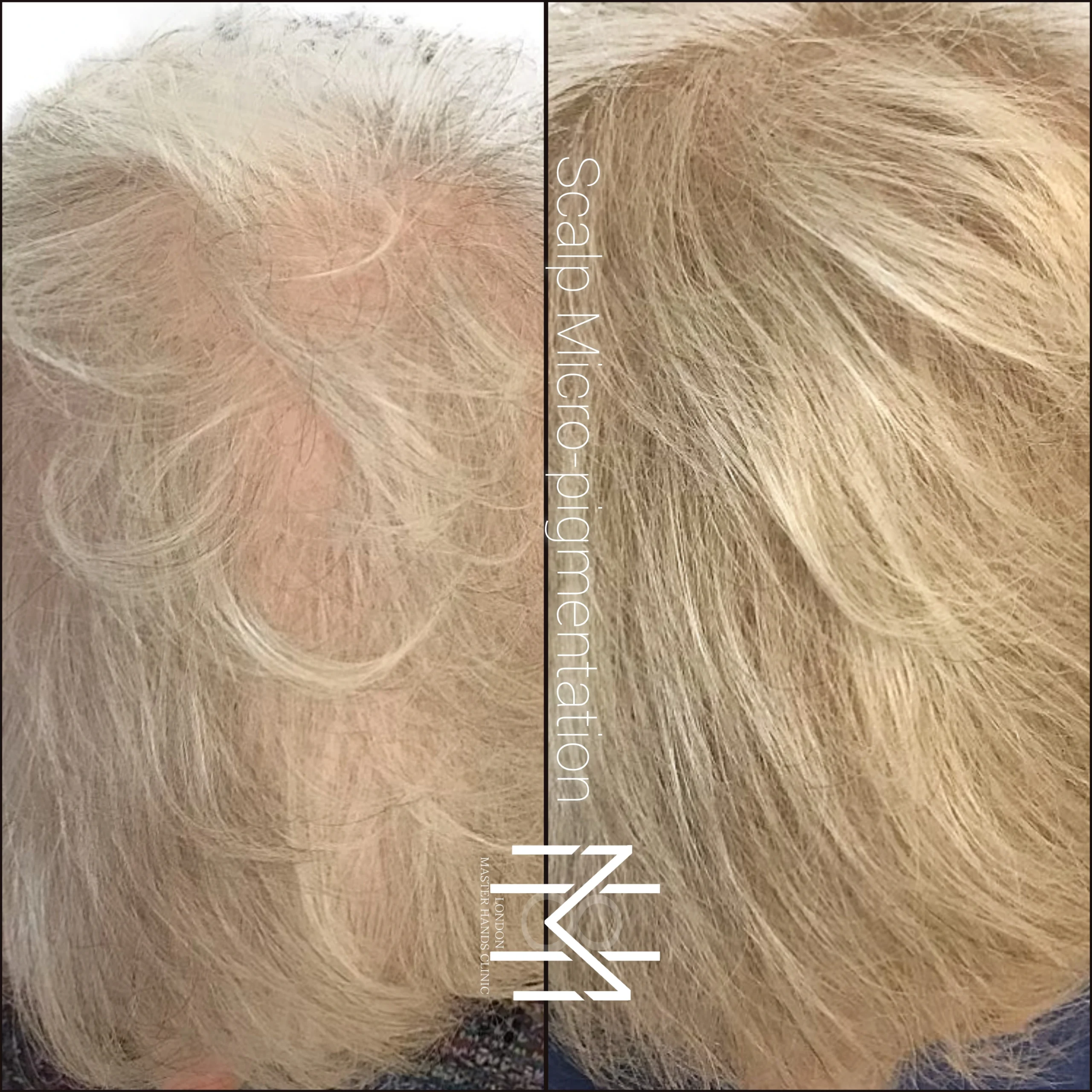 scalp micropigmentation and hairline SPM in london