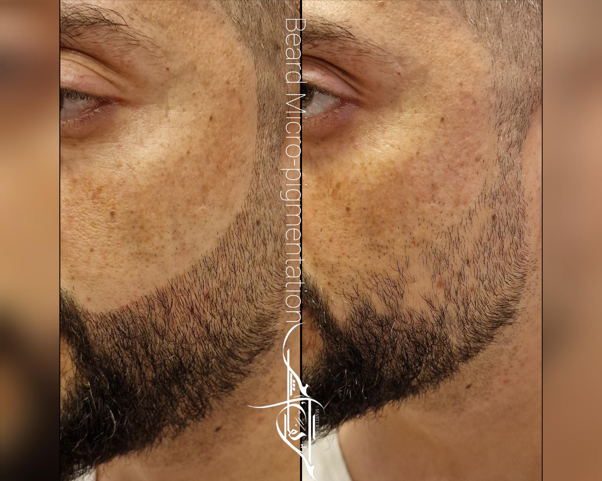 beard micropigmentation