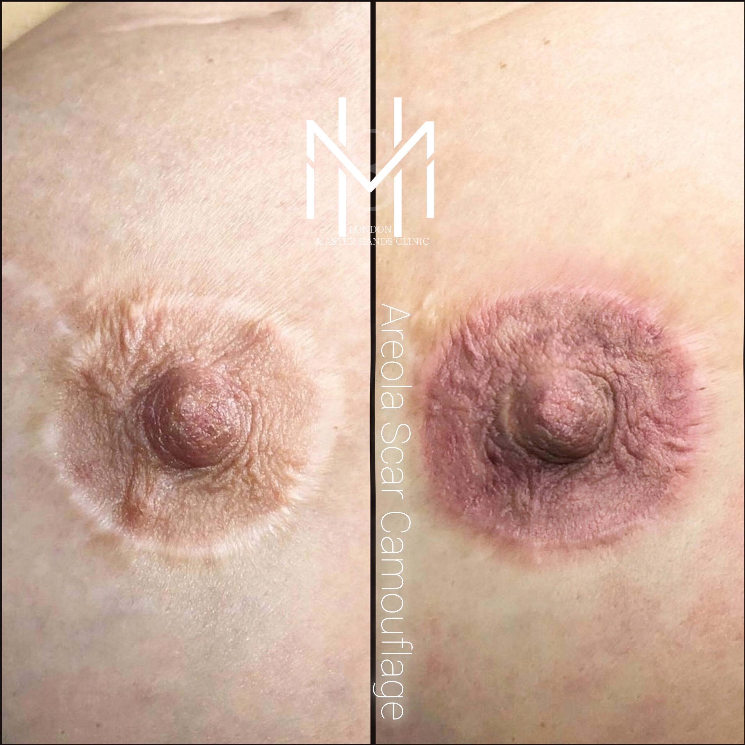 london clinic Cancer Breast Tattoo